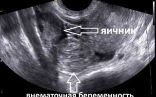 Внематочная беременность — как определить на ранних сроках?