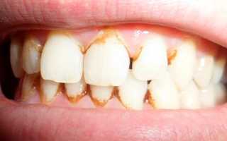 Как выглядит зубной камень (фото). Удаление в домашних условиях и в клинике