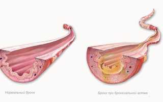 Чем опасна бронхиальная астма и можно ли ее вылечить?