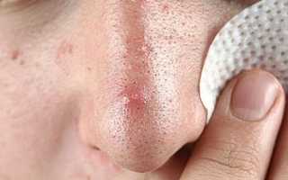 Комедоны на лице — почему возникают и как с ними бороться?