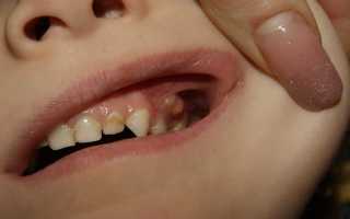 Свищ на десне у ребенка — симптомы и лечение, народные методики