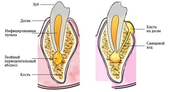 На фото показан свищ и свищевой канал. Инфицированная пульпа спровоцировала гнойный периодонтальный абсцесс, который через свищевой ход вытекает в новообразование - внешний свищ на десне.