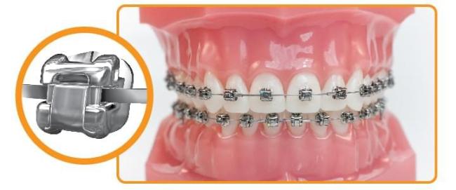 Брекеты DamonQ - лучшие металлические самолигирующие брекеты, подходят для исправления прикуса взрослым и детям старше 12-ти лет