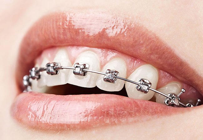 Брекеты - несъемные ортопедические конструкции, предназначенные для исправления неправильного прикуса