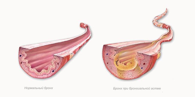 Самым распространённым легочным заболеванием является бронхиальная астма