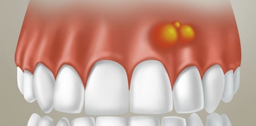 Появление гнойника на десне - фото пример иллюстрации.