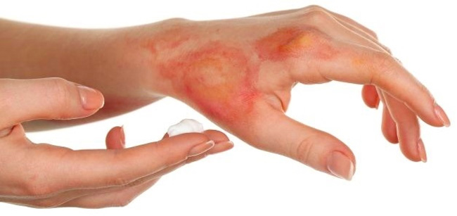 Активные вещества мази Флуцинар проникают в глубокие слои кожи и сохраняются достаточно долго в роговом слое