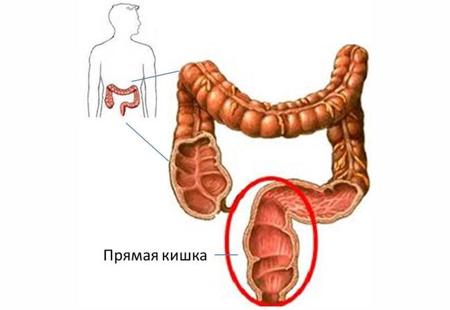 На развитие острого проктита нужно всего несколько часов.