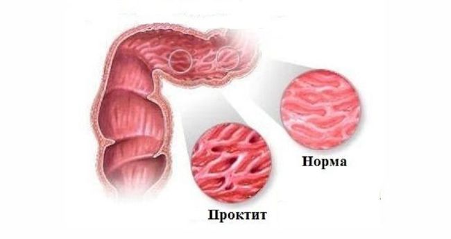 Во время проктита воспаляется слизистая прямой кишки, что сопровождается множеством неприятных факторов.
