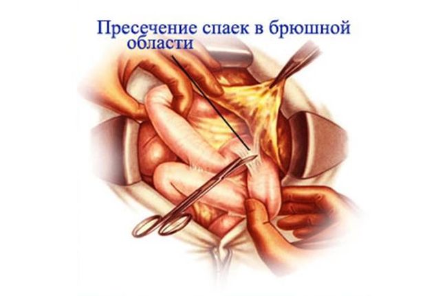 На фото показано пресечение спаек в брюшной области