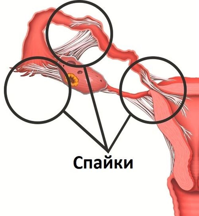 Спайки в малом тазу