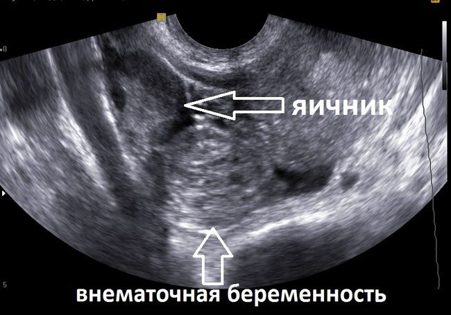 Внематочная беременность - опасное гинекологическое заболевание