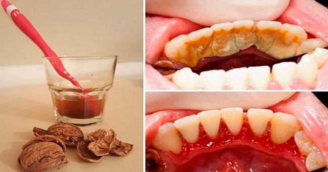 Если камень только появился и еще не успел затвердеть, может помочь измельченная кора грецкого ореха