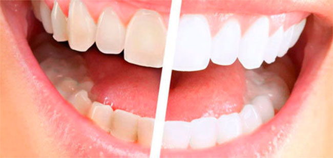 Очищение зубов с помощью метода пескоструйной обработки применяется для восстановления природного цвета эмали, который утрачен в результате курения или частого применения продуктов с красящими пигментами